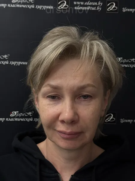 Эндоскопическая подтяжка лба: до операции
