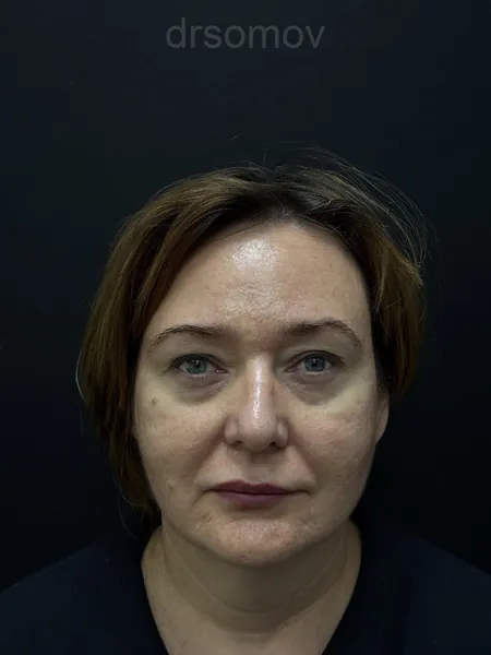 Верхняя блефаропластика: до операции