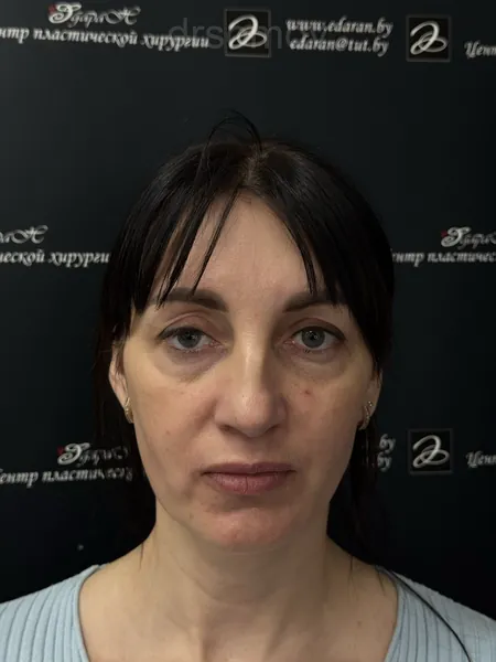 Верхняя и нижняя блефаропластика: до операции