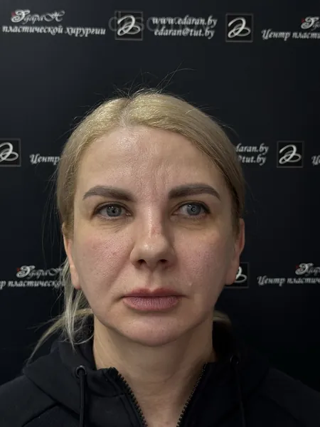 Эндоскопическая подтяжка лба: до операции