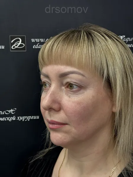 Верхняя блефаропластика: до операции