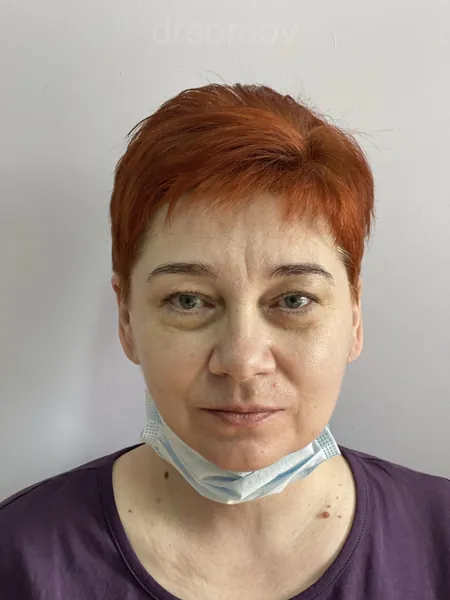 Нижняя блефаропластика: до операции