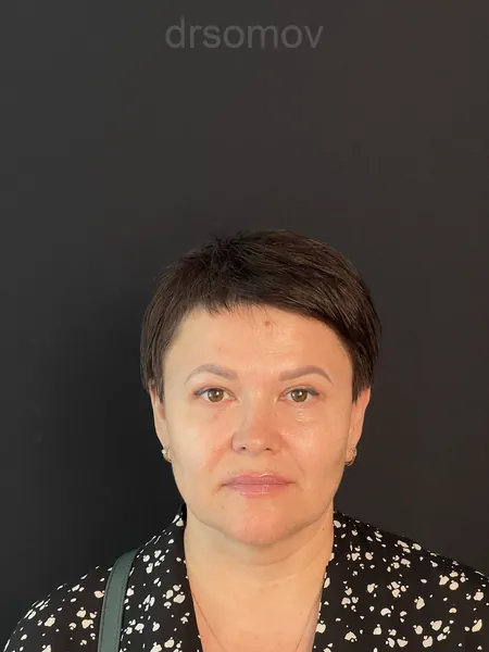 Верхняя блефаропластика: после операции