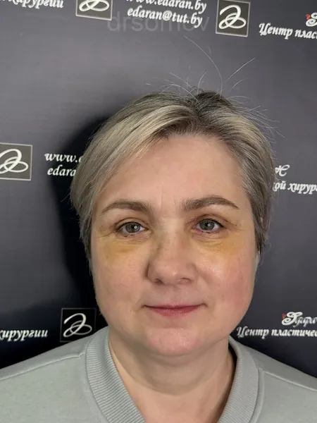 Верхняя и нижняя блефаропластика: после операции