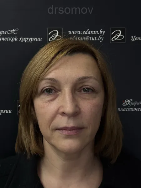 Верхняя и нижняя блефаропластика: до операции