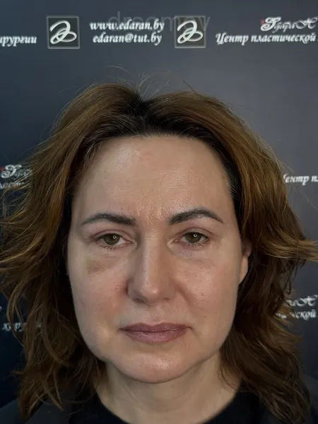 Верхняя и нижняя блефаропластика: после операции
