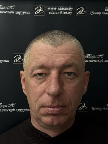Верхняя блефаропластика: до операции