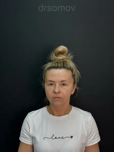 Подтяжка лица и шеи: до операции