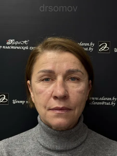 Подтяжка лица и шеи: до операции