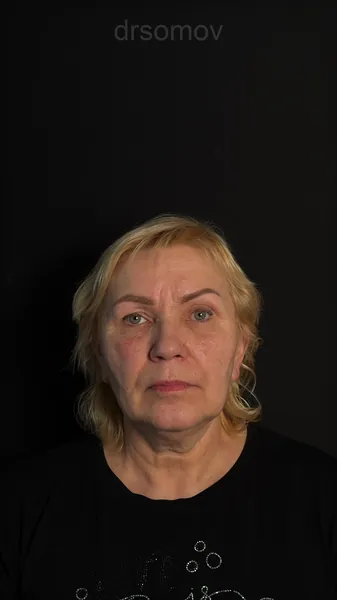 Подтяжка лица и шеи: до операции