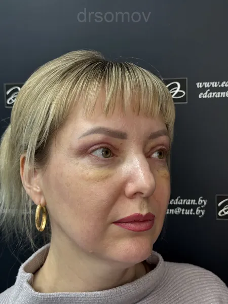 Верхняя блефаропластика: после операции